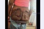 Butt-implants.jpg